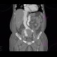 Aortocaval fistula, aneurysm of abdominal aorta, AAA: CT - Computed tomography